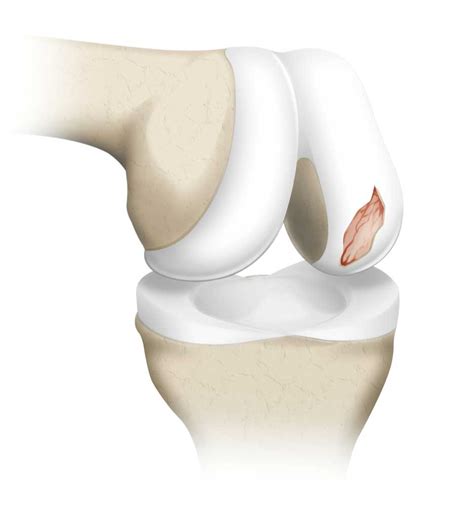 Focal Articular Cartilage Defect | Orthopedic Knee Specialist | Vail ...