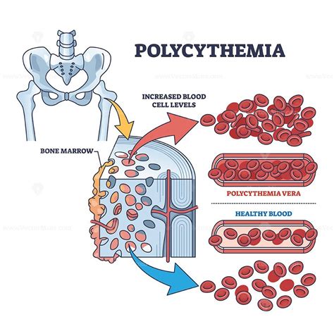 Polycythemia vera blood cancer type with increased red cells outline diagram - VectorMine