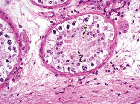 Seminoma Histologia