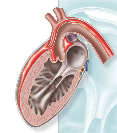 Aortic Dissection - Temple Health