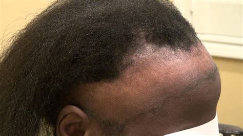 Tips on how to combat a receding hairline | Review