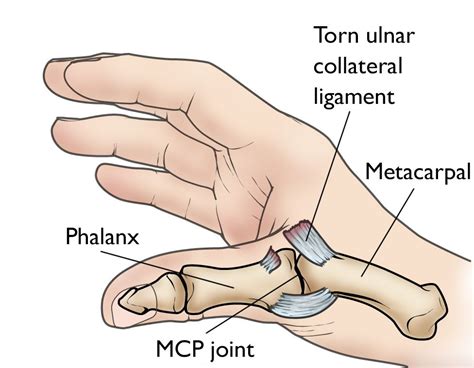 Ulnar Collateral Ligament Thumb Splint