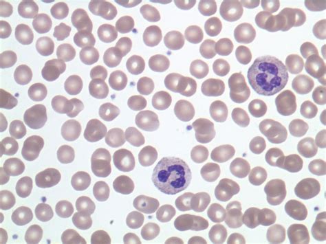 Medical Pictures Info – Acute Lymphoblastic Leukemia