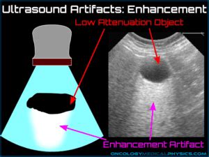 Ultrasound Artifacts | Oncology Medical Physics