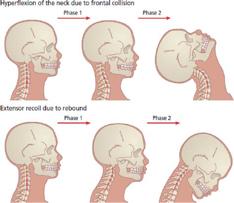 Hyperextension of cervical spine during whiplash injury [10 ...