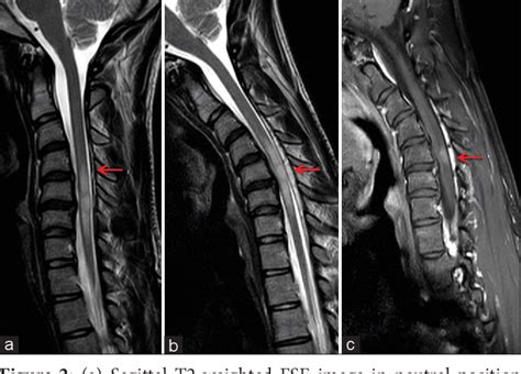 Figure 2 from Hirayama disease – Early MRI diagnosis of subacute ...