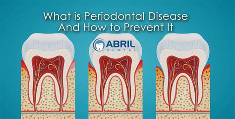 What is Periodontal Disease And How to Prevent It - Abril Dentist