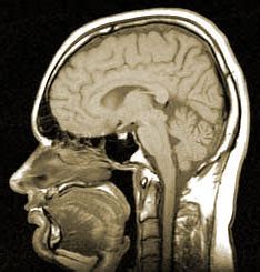 MRI after Concussion: Magnetic Resonance Imaging