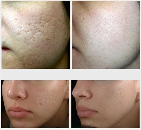 Effective Acne Scar Treatment For Brides To Be - Feel Good Laser and Skin