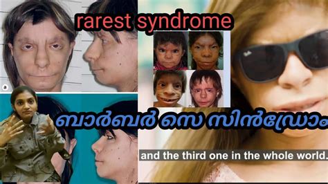 Barber say syndrome rarest syndrome #truly #btv #netflix - YouTube