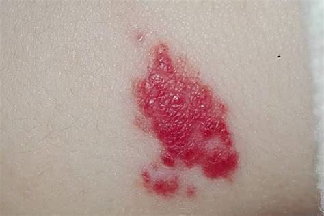 Skin Lesions: Types with Chart, Pictures, Causes, Treatment