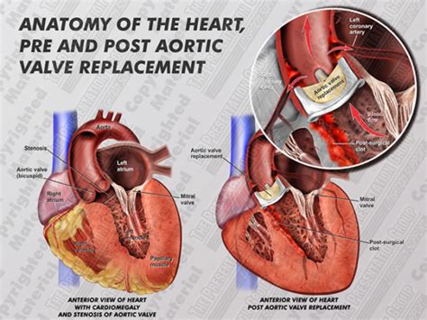 Mechanical Aortic Valve Replacement