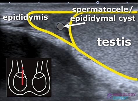 Scrotal ultrasound