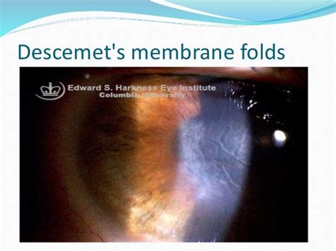 Corneal edema after cataract surgery - MALEK AL KOTT