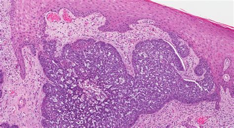 Узловая базально-клеточная карцинома | MyPathologyReport.ca