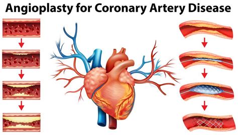 11+ Heart Artery Diagram | Robhosking Diagram