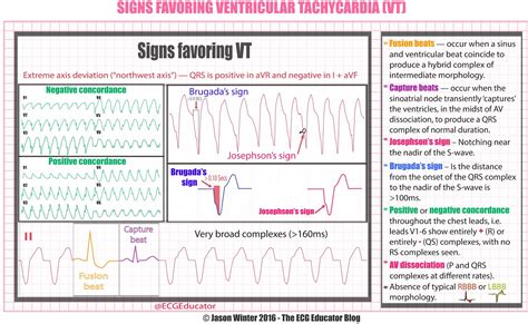 ECG Educator Blog : Is it VT?