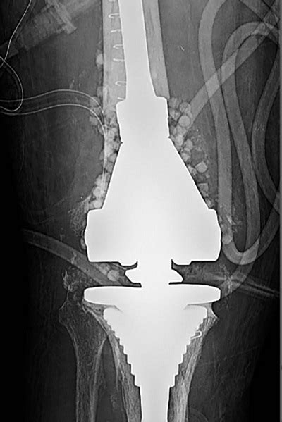 Chronic Periprosthetic Joint Infection | HSS Case