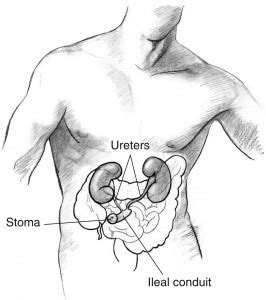 Urostomy or Urinary Diversion