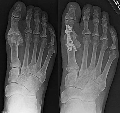 Arthritis of the Big Toe (Hallux Rigidus): What Are My Treatment Options? | OrthoVirginia