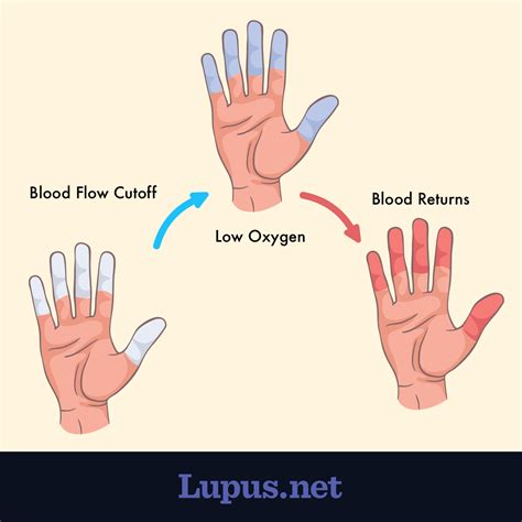 How are Raynaud's and Lupus Related?