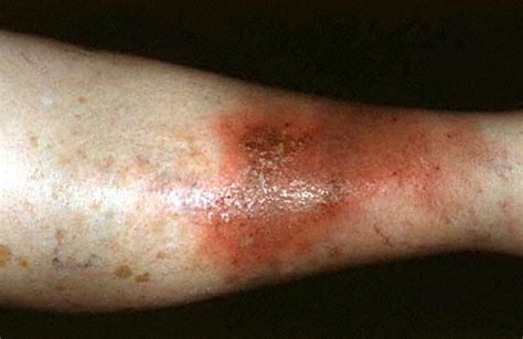 Cellulitis - Pictures, Symptoms, Treatment, Contagious, Causes, Types ...