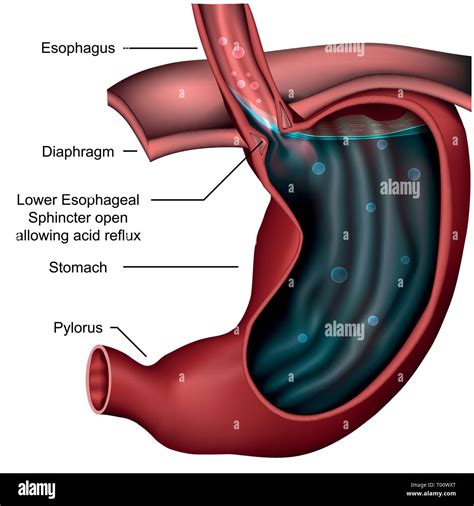 Esophagealsphincter anatomy Reflux 3d medical vector illustration Stock Vector Image & Art - Alamy