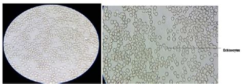 Presence of Echinocytes in peripheral blood smear of Lachesis muta 30. | Download Scientific Diagram