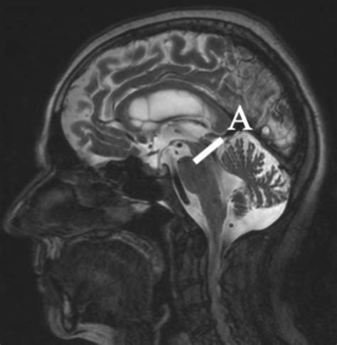 Midsagittal T2 MRI depicting cerebral aqueduct. Image shows the... | Download Scientific Diagram