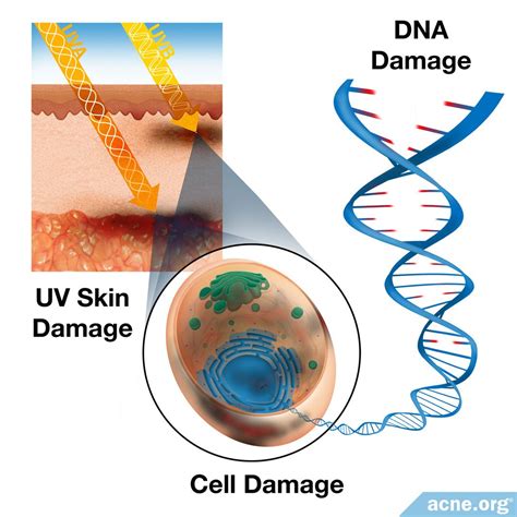 What's the Difference Between UVA and UVB Rays? - Acne.org