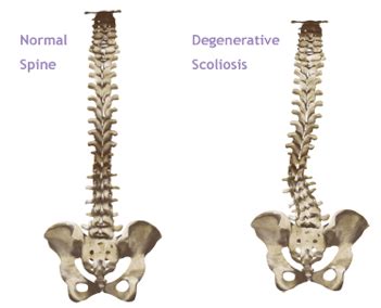 XLIF Surgery | XLIF Procedure | Lateral Access Spine Surgery | Virginia