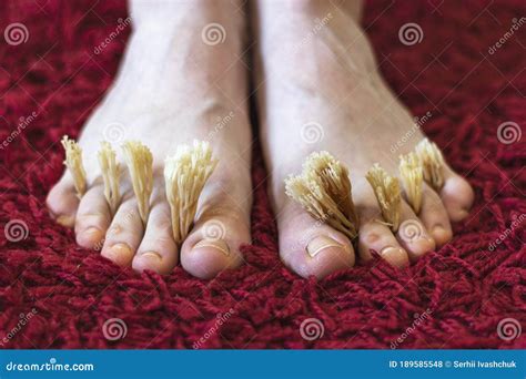 Coral Fungus between the Toes of Female Feet. Concept of Fungal Skin ...