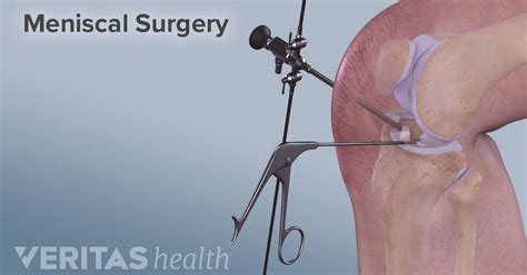 Knee Cartilage Repair, Regeneration, and Replacement | Meniscus surgery, Meniscus tear, Torn ...