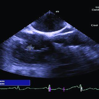 Preoperative transesophageal echocardiogram (TEE) showing severe mitral ...