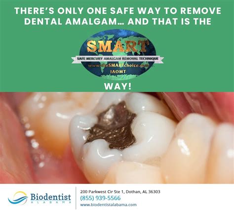 There's Only One Safe Way to Remove Dental Amalgam.. and That is The Smart Way! in 2021 ...