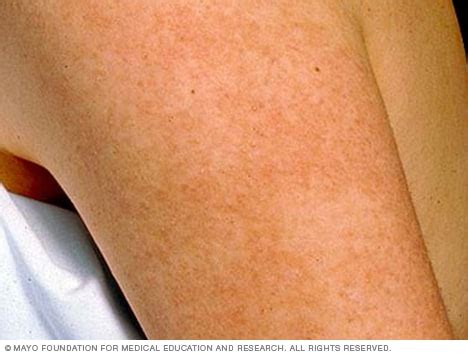 Keratosis pilaris - Symptoms and causes - Mayo Clinic