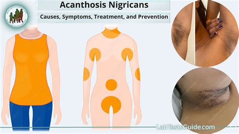 Acanthosis Nigricans: Causes, Symptoms, Treatment, and Prevention