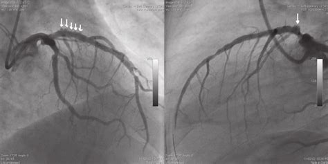 A coronary artery aneurysm after the Genous TM stent placement in... | Download Scientific Diagram