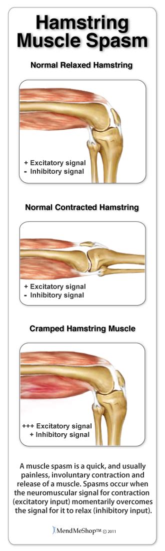 Hamstring Muscle Spasm