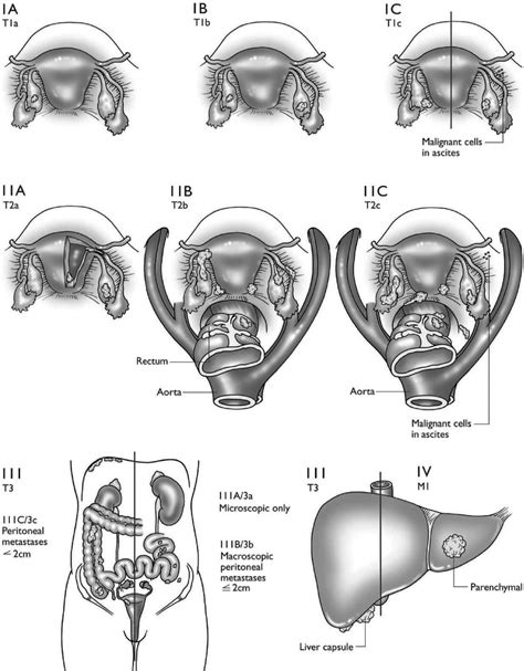 Carcinoma of the ovary. Staging ovarian cancer: primary tumor and ...