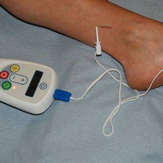 Posterior tibial nerve stimulation | Download Scientific Diagram