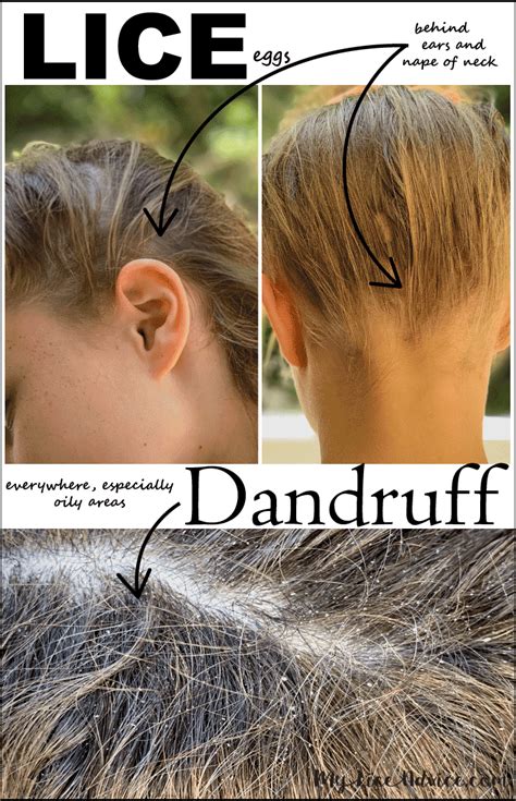 Lice vs Dry Scalp - Learn the 7 Key Differences Between Lice Eggs and Dandruff | Lice eggs ...