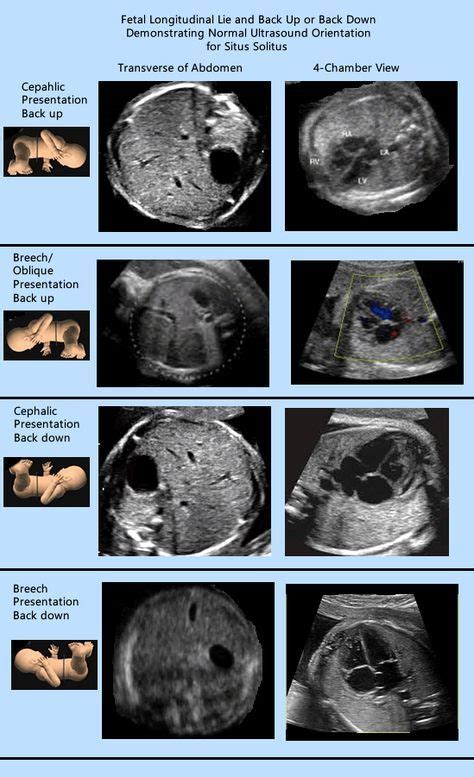 1Final.Normalsitus1 | Ultrasound, Medical ultrasound, Obstetric ultrasound