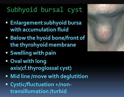 Subhyoid bursal cyst - MEDizzy