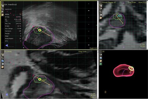 Fusion Biopsy - ASUI