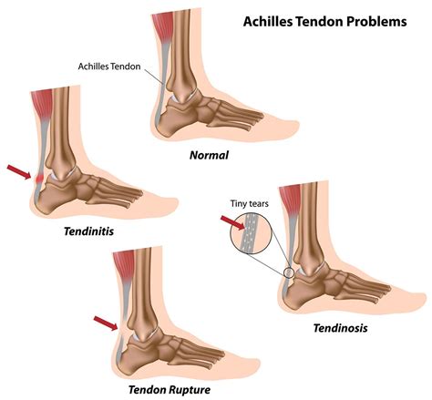 Achilles tendon injuries | healthdirect