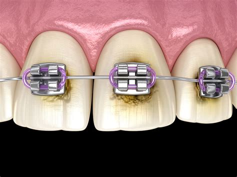 A Guide to Flossing While Wearing Braces