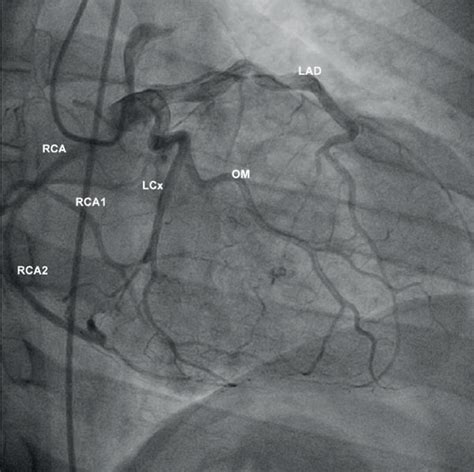 (a, b) Coronary angiography (right anterior oblique projection)... | Download Scientific Diagram