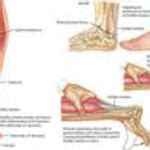 Calcaneal Tendon Rupture