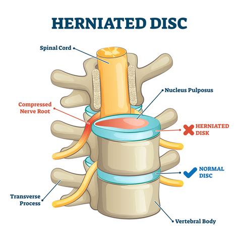 What Happens if the Herniated Disc in Your Back is Left Untreated?